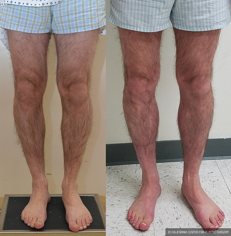 Calf Augmentation Before & After Patient #13680