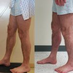 Calf Augmentation Before & After Patient #13680
