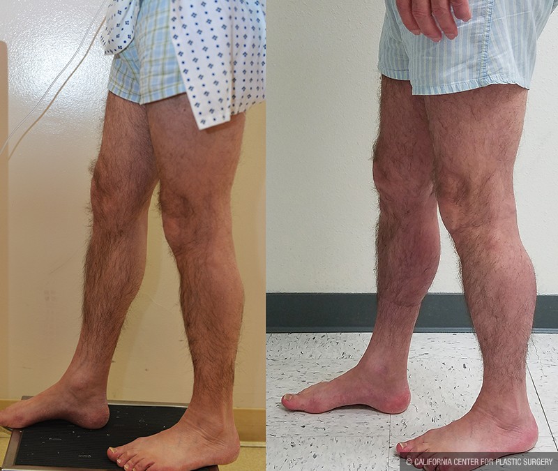 Calf Augmentation Before & After Patient #13680