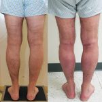 Calf Augmentation Before & After Patient #13680