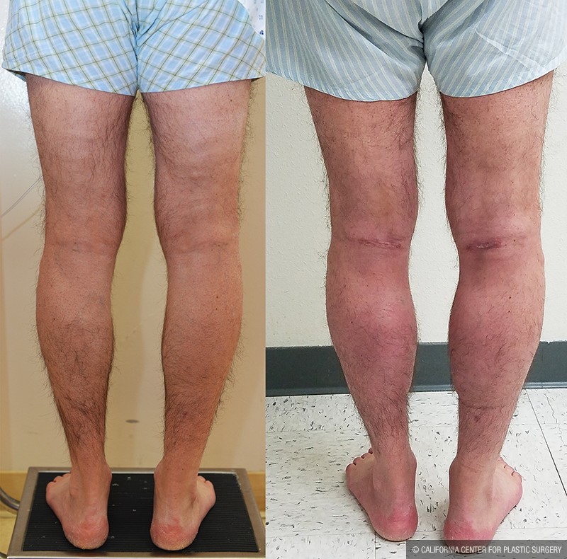Calf Augmentation Before & After Patient #13680