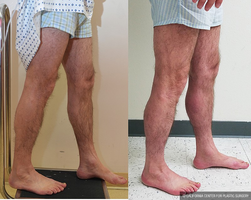 Calf Augmentation Before & After Patient #13680