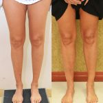 Calf Augmentation Before & After Patient #13681