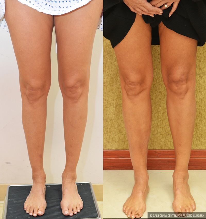 Calf Augmentation Before & After Patient #13681