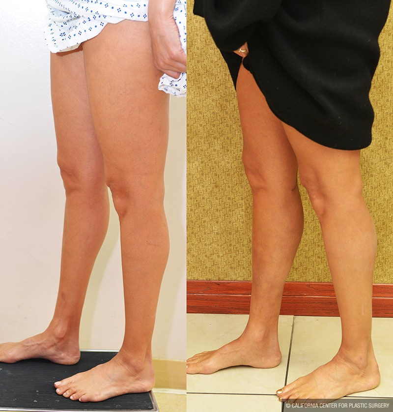 Calf Augmentation Before & After Patient #13681