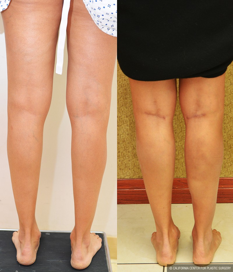 Calf Augmentation Before & After Patient #13681