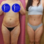 Tummy Tuck (Abdominoplasty) Medium Size Before & After Patient #13684