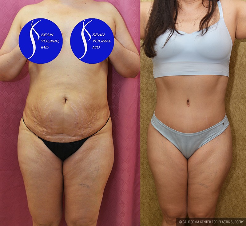 Tummy Tuck (Abdominoplasty) Medium Size Before & After Patient #13684