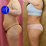 Tummy Tuck (Abdominoplasty) Medium Size Before & After Patient #13684