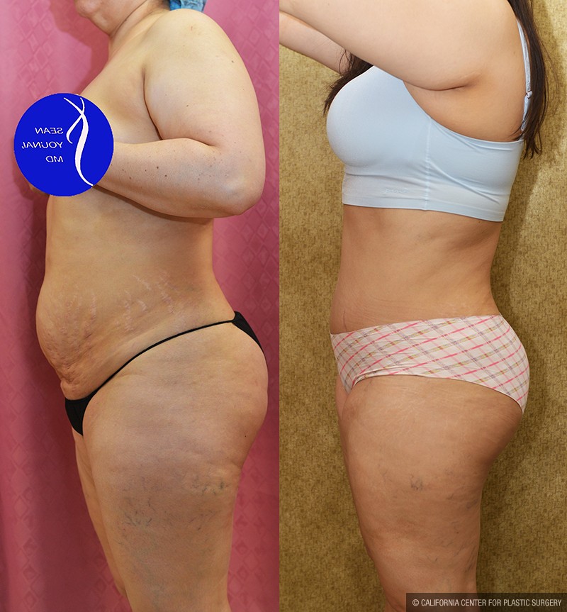 Tummy Tuck (Abdominoplasty) Medium Size Before & After Patient #13684