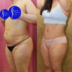 Tummy Tuck (Abdominoplasty) Medium Size Before & After Patient #13684