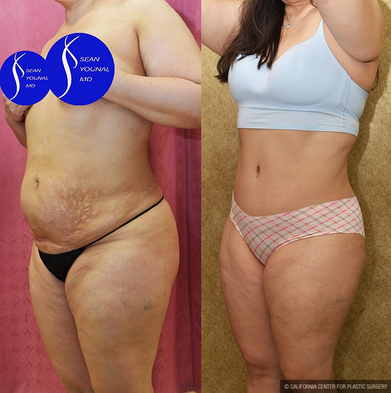 Tummy Tuck (Abdominoplasty) Medium Size Before & After Patient #13684