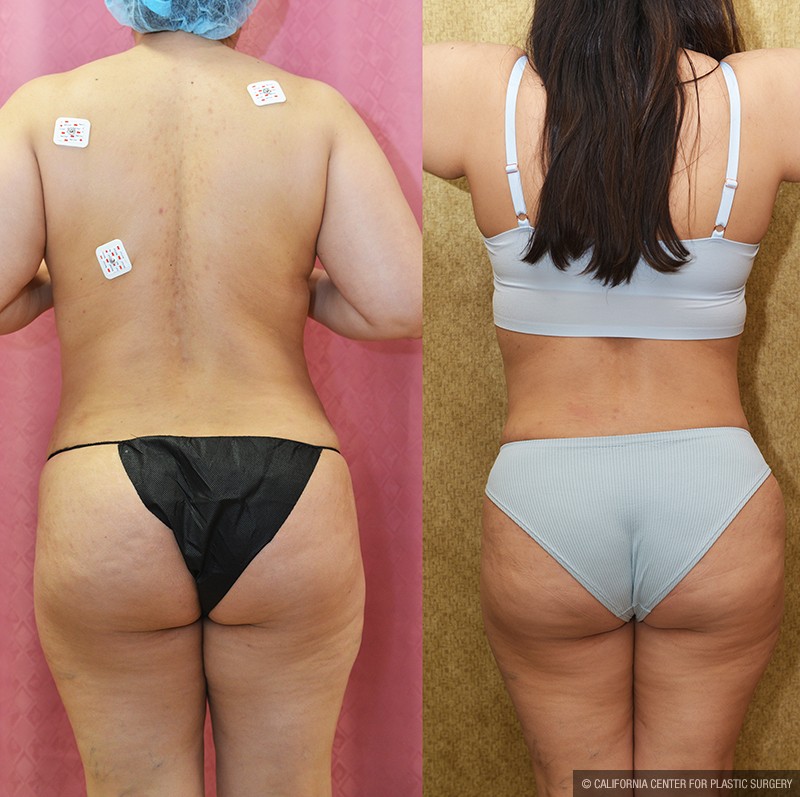 Tummy Tuck (Abdominoplasty) Medium Size Before & After Patient #13684