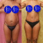 Tummy Tuck (Abdominoplasty) Small Size Before & After Patient #13688