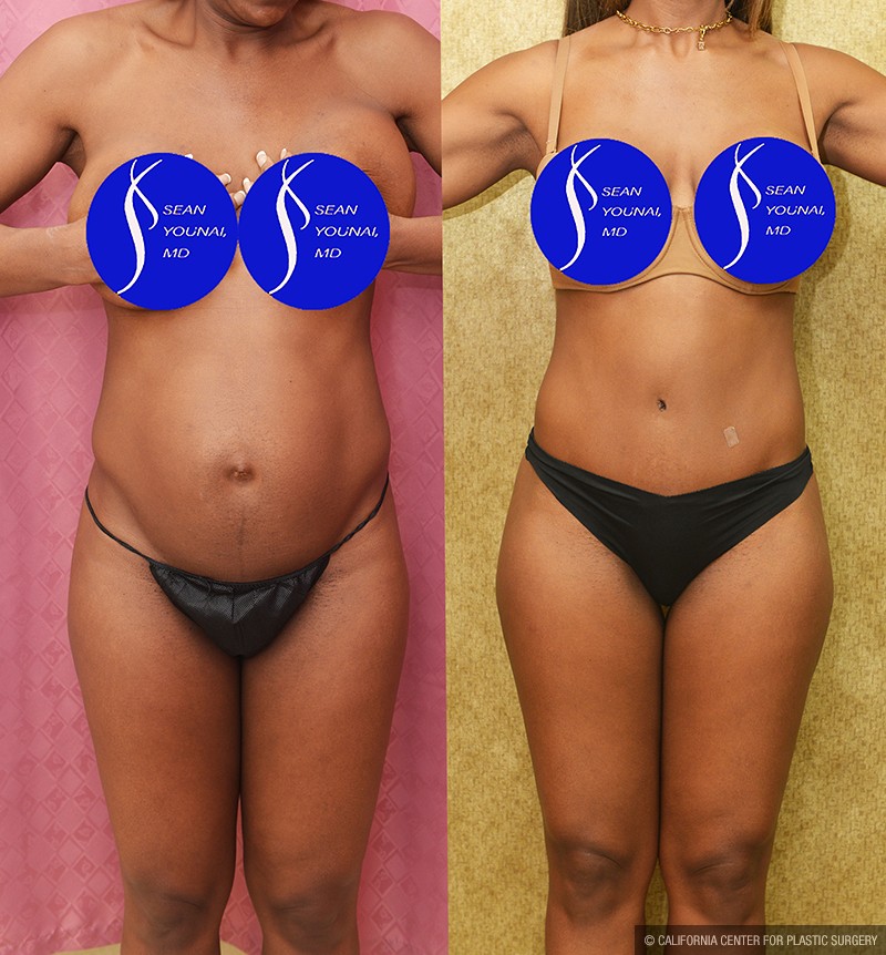 Tummy Tuck (Abdominoplasty) Small Size Before & After Patient #13688