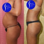 Tummy Tuck (Abdominoplasty) Small Size Before & After Patient #13688
