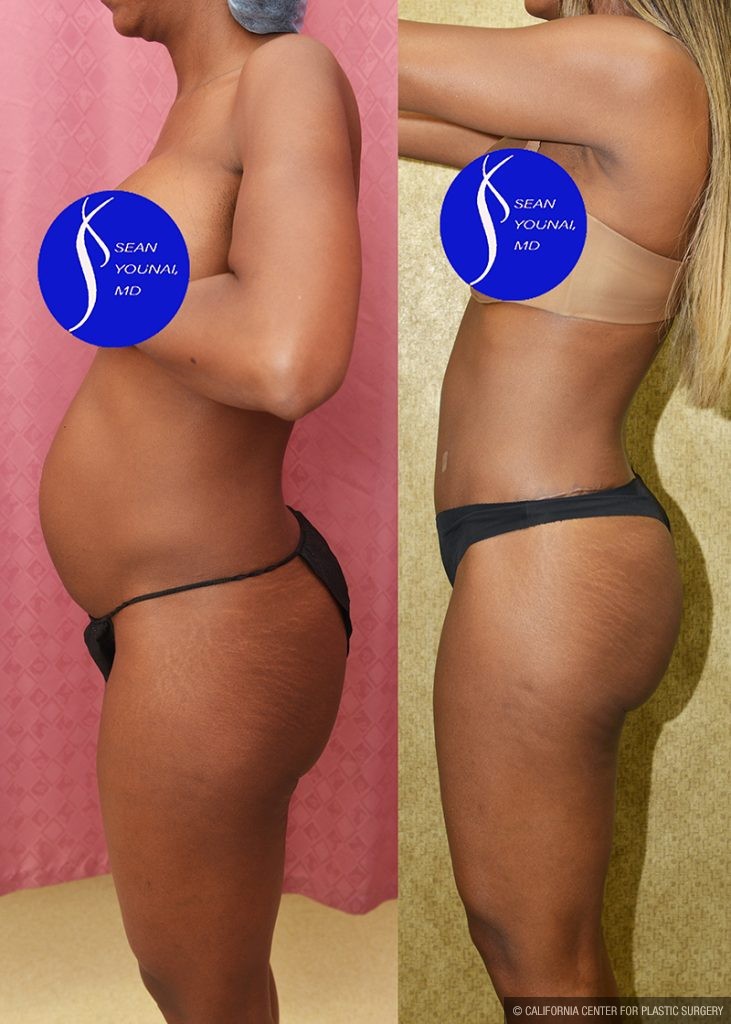 Tummy Tuck (Abdominoplasty) Small Size Before & After Patient #13688