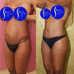 Tummy Tuck (Abdominoplasty) Small Size Before & After Patient #13688