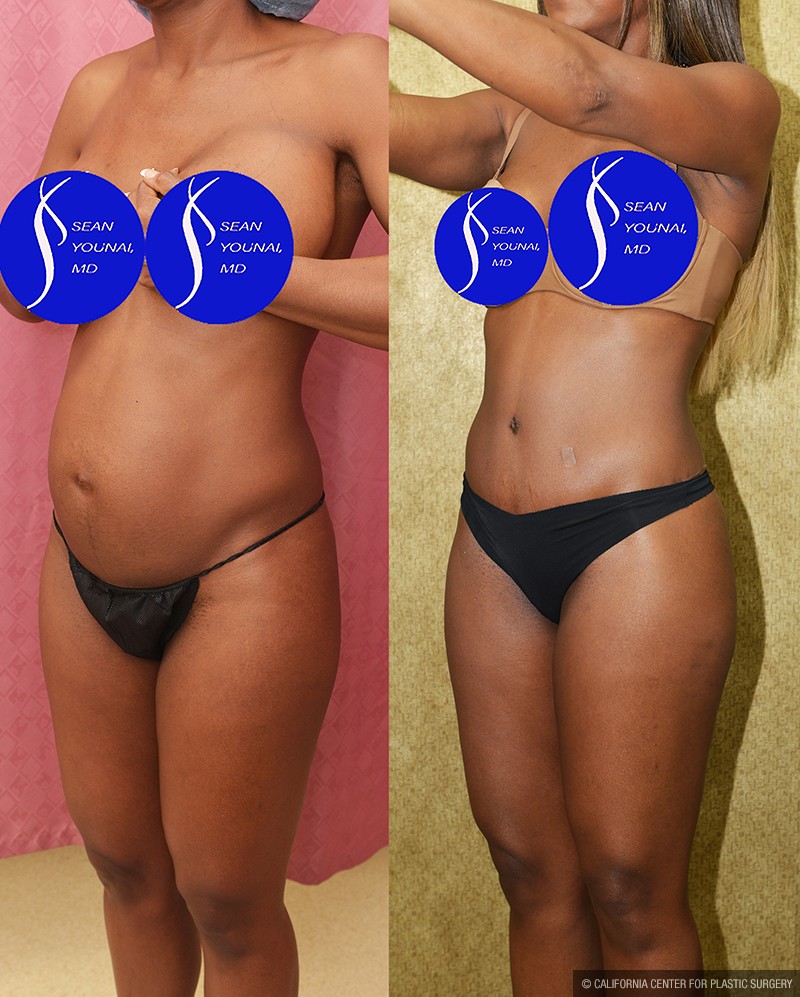 Tummy Tuck (Abdominoplasty) Small Size Before & After Patient #13688