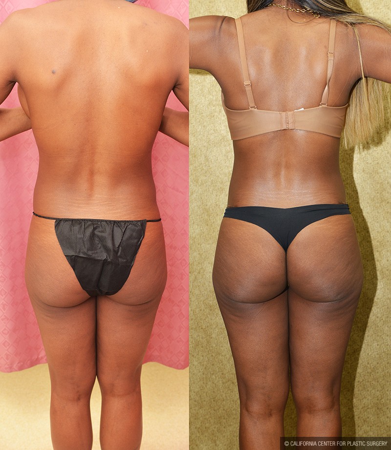 Tummy Tuck (Abdominoplasty) Small Size Before & After Patient #13688