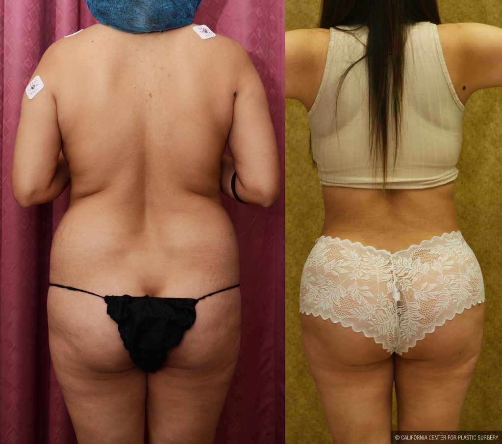 Buttock Lift/Augmentation Before & After Patient #13755