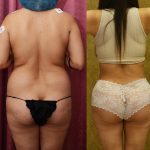 Buttock Lift/Augmentation Before & After Patient #13755