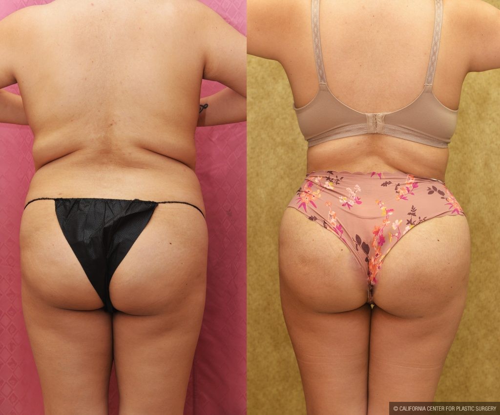 Buttock Lift/Augmentation Before & After Patient #13756