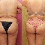 Buttock Lift/Augmentation Before & After Patient #13756