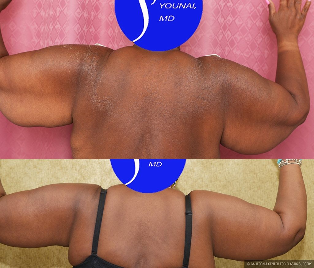 Arm Lift (Brachioplasty) Before & After Patient #13753