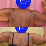 Arm Lift (Brachioplasty) Before & After Patient #13753