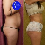 Buttock Lift/Augmentation Before & After Patient #13755
