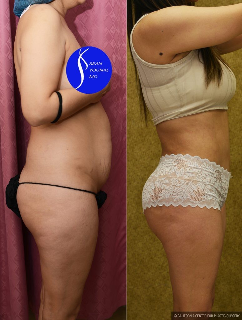 Buttock Lift/Augmentation Before & After Patient #13755