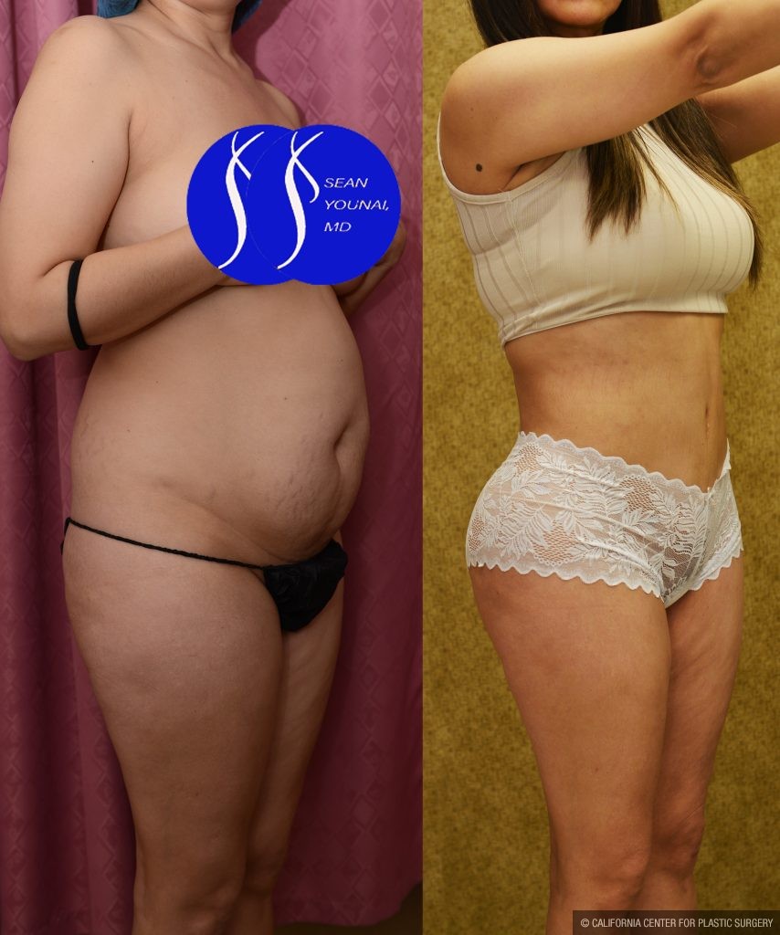 Tummy Tuck (Abdominoplasty) Small Size Before & After Patient #13764