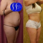 Buttock Lift/Augmentation Before & After Patient #13755