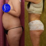 Tummy Tuck (Abdominoplasty) Small Size Before & After Patient #13764