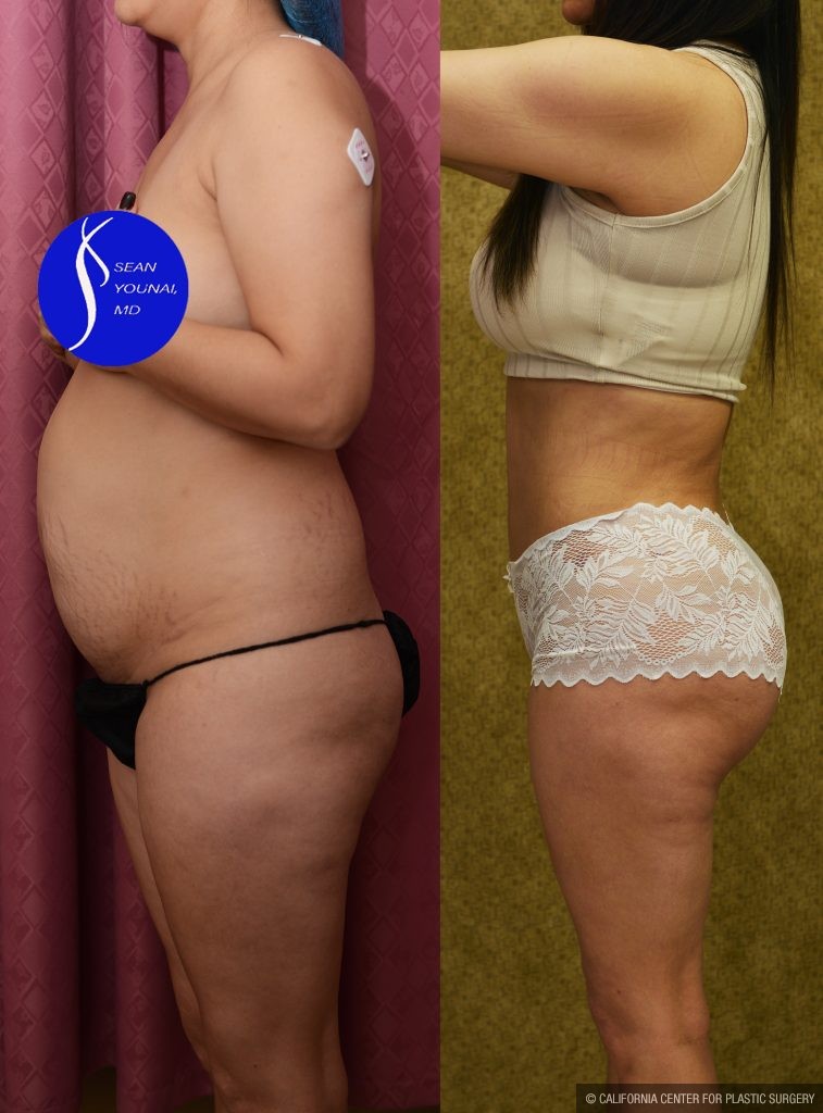 Buttock Lift/Augmentation Before & After Patient #13755