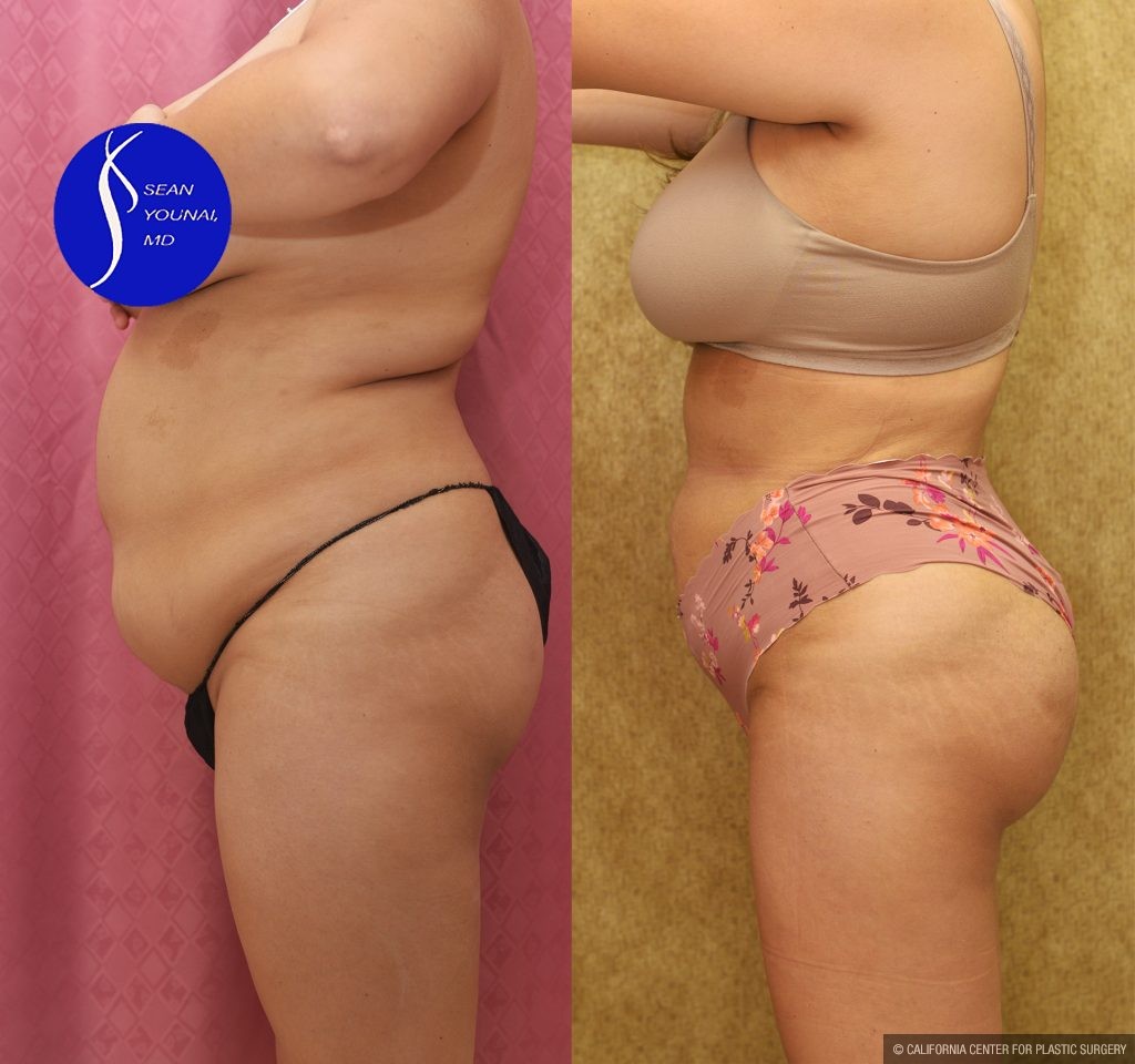 Buttock Lift/Augmentation Before & After Patient #13756