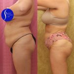 Buttock Lift/Augmentation Before & After Patient #13756