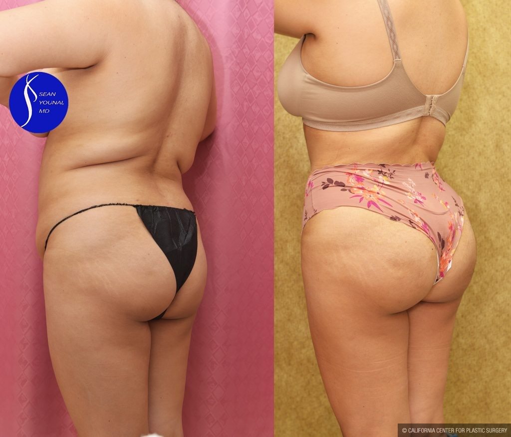 Buttock Lift/Augmentation Before & After Patient #13756
