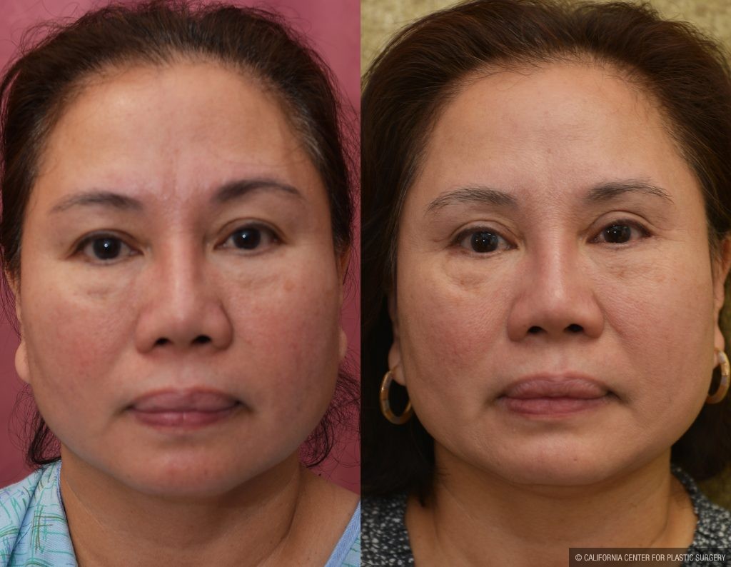 Asian Eyelid Surgery (Blepharoplasty) Before & After Patient #13758