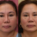Asian Eyelid Surgery (Blepharoplasty) Before & After Patient #13758