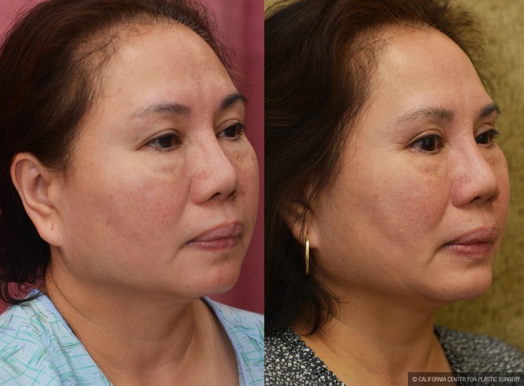 Asian Eyelid Surgery (Blepharoplasty) Before & After Patient #13758