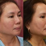 Asian Eyelid Surgery (Blepharoplasty) Before & After Patient #13758