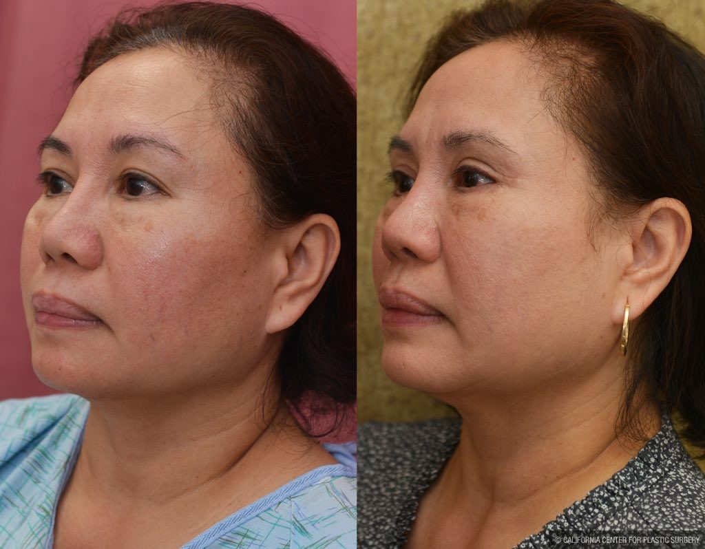 Asian Eyelid Surgery (Blepharoplasty) Before & After Patient #13758