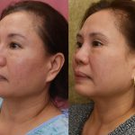 Asian Eyelid Surgery (Blepharoplasty) Before & After Patient #13758