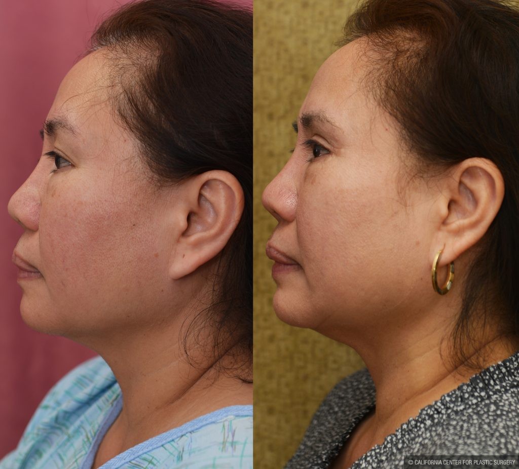 Asian Eyelid Surgery (Blepharoplasty) Before & After Patient #13758