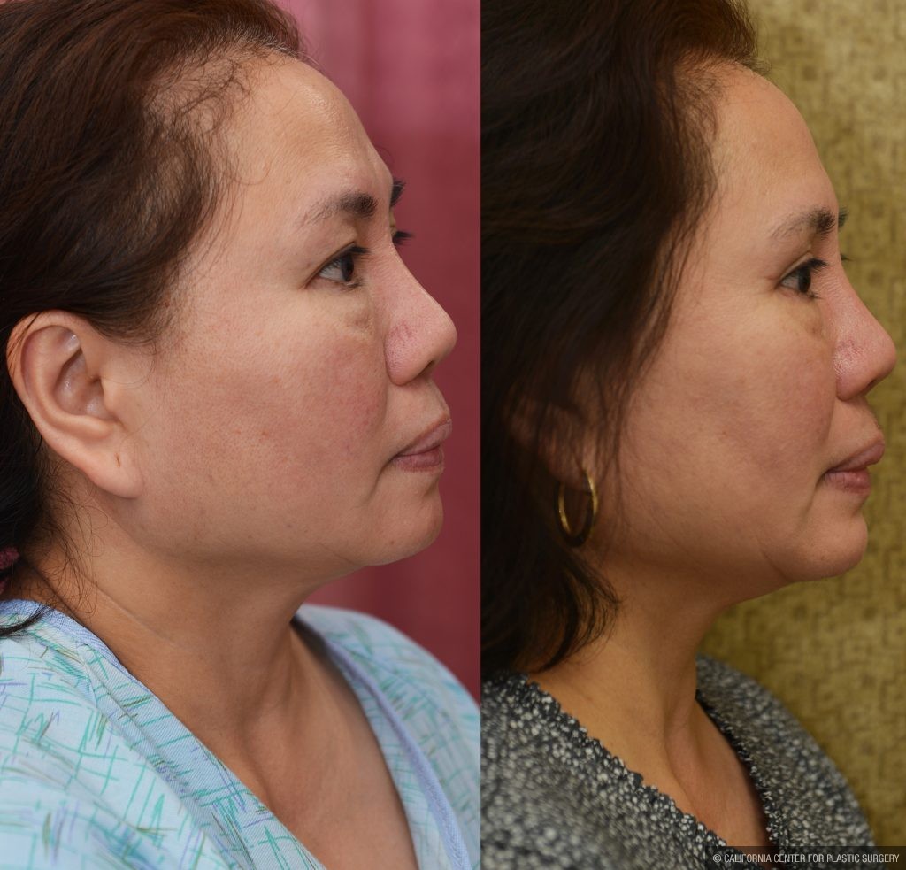 Asian Eyelid Surgery (Blepharoplasty) Before & After Patient #13758