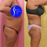 African American Tummy Tuck (Abdominoplasty) Before & After Patient #13759