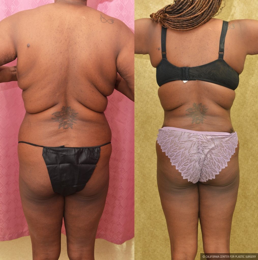African American Tummy Tuck (Abdominoplasty) Before & After Patient #13759