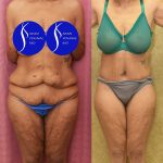 Tummy Tuck (Abdominoplasty) Plus Size Before & After Patient #13761